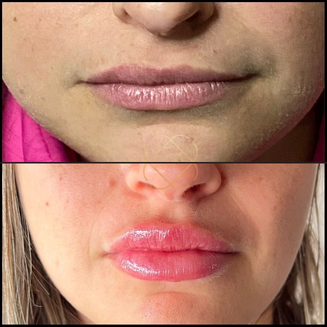 Preenchimento Labial