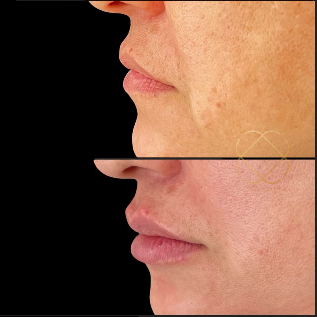 Preenchimento Labial